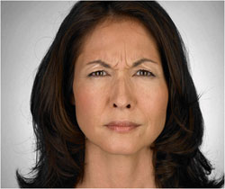 Angela before her Botox treatment