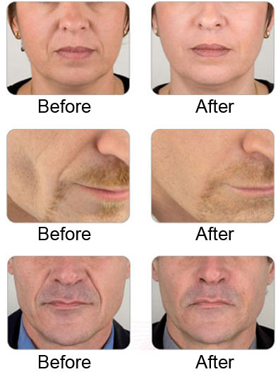 Dermal Fillers Malta dentist