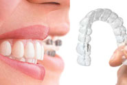 Invisalign Braces