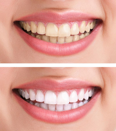 Teeth whitening from Malta dentist